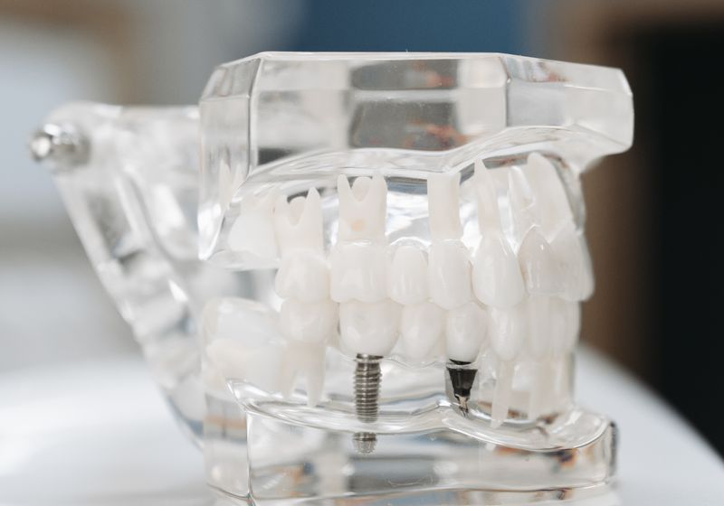 Dental implant model demonstrating tooth replacement