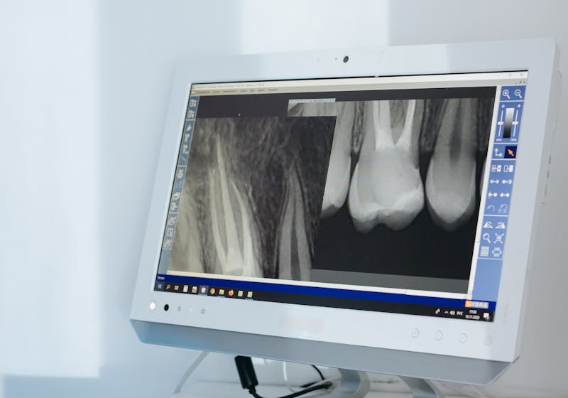 Root canal therapy to save an infected tooth at a Hamilton dental clinic